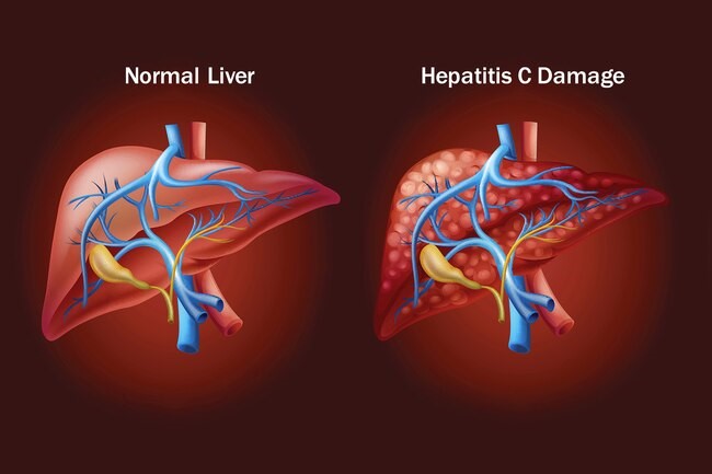 Hepatitis С